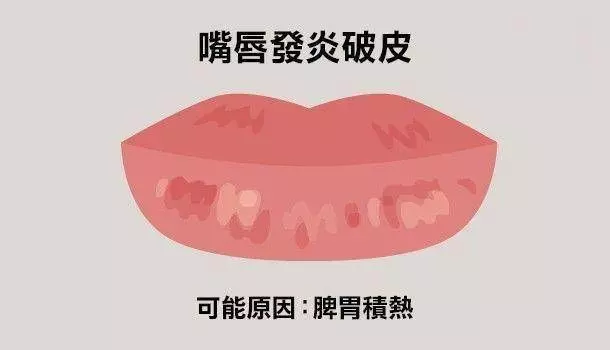 6種常見唇色看健康，嘴唇乾裂、破皮、偏白是什麼狀況？