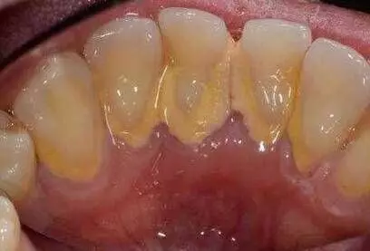 牙垢太多很難清理？教你8個小竅門，不用去醫院洗牙，牙結石、口臭都解決